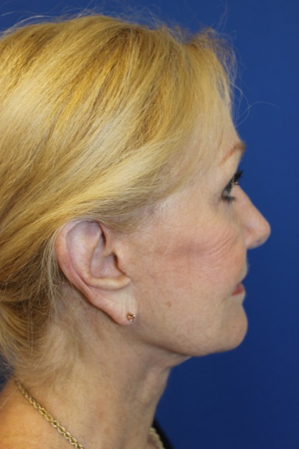 Follicular Unit Extraction Before & After Patient #3811