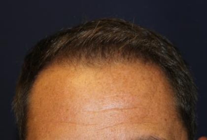 Follicular Unit Extraction Before & After Patient #3589
