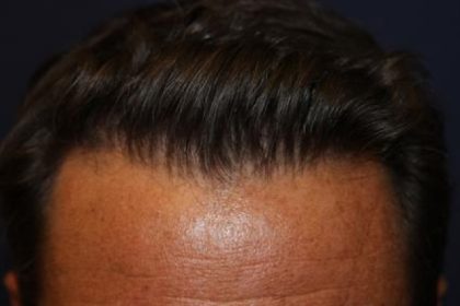 Follicular Unit Extraction Before & After Patient #3589