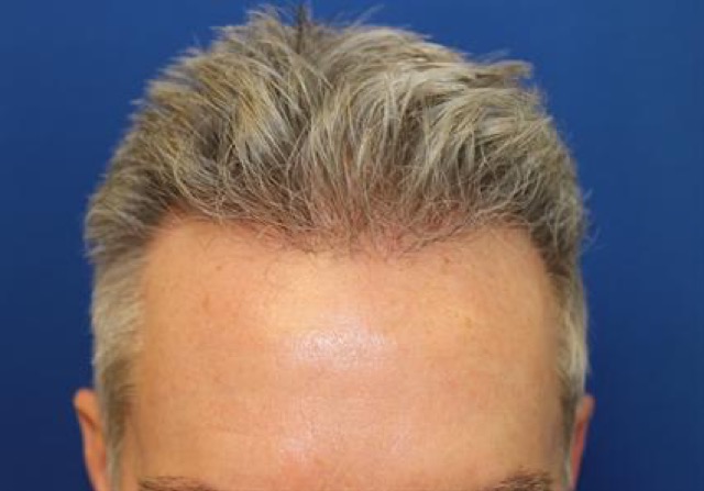 Follicular Unit Extraction Before & After Patient #3665