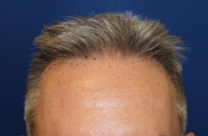 Follicular Unit Extraction Before & After Patient #3665