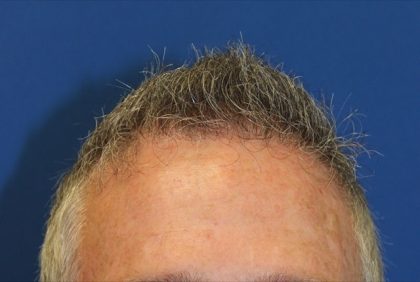 Follicular Unit Extraction Before & After Patient #3505