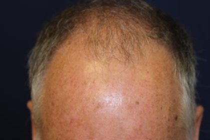 Follicular Unit Extraction Before & After Patient #3594