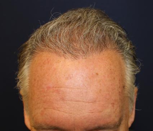 Follicular Unit Extraction Before & After Patient #3594