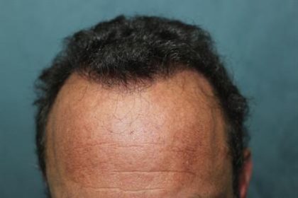Follicular Unit Extraction Before & After Patient #3614