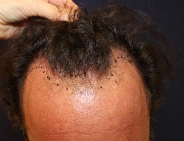 Follicular Unit Extraction Before & After Patient #3614