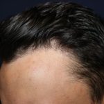 Follicular Unit Extraction Before & After Patient #3776