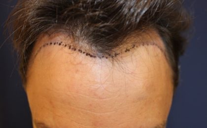 Follicular Unit Extraction Before & After Patient #3776