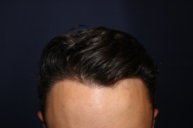 Follicular Unit Extraction Before & After Patient #3776