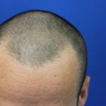 Follicular Unit Extraction Before & After Patient #3740