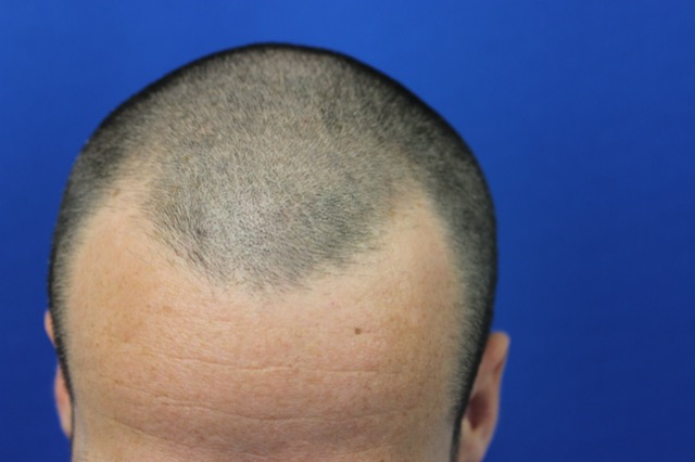 Follicular Unit Extraction Before & After Patient #3740