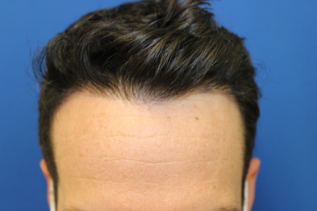Follicular Unit Extraction Before & After Patient #3740