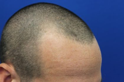 Follicular Unit Extraction Before & After Patient #3740
