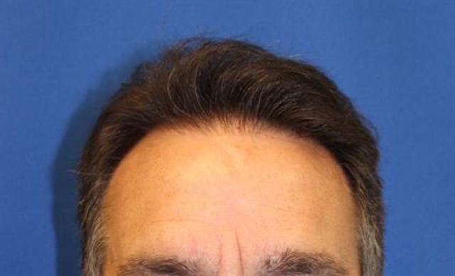 Follicular Unit Extraction Before & After Patient #3662