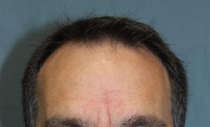 Follicular Unit Extraction Before & After Patient #3662