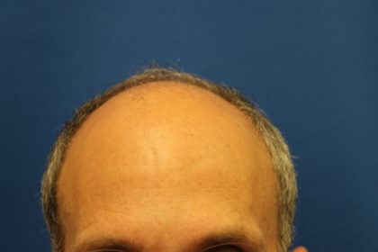 Follicular Unit Extraction Before & After Patient #3686