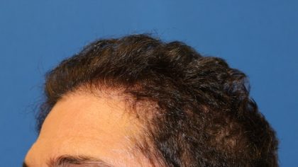 Follicular Unit Extraction Before & After Patient #3704