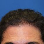 Follicular Unit Extraction Before & After Patient #3704