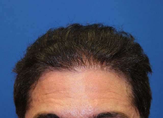Follicular Unit Extraction Before & After Patient #3704