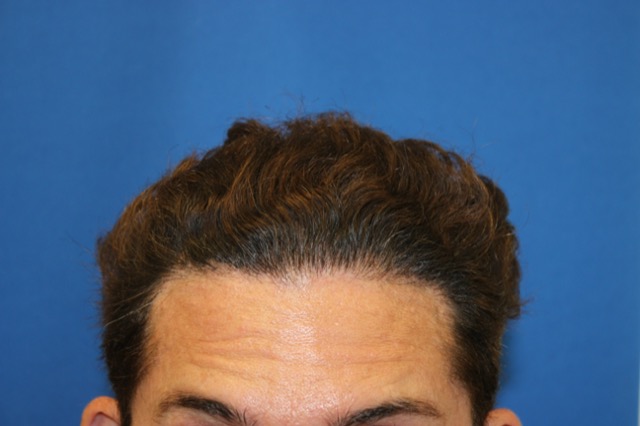 Follicular Unit Extraction Before & After Patient #3704