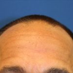 Follicular Unit Extraction Before & After Patient #3791