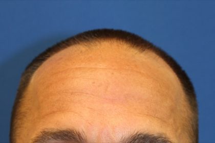 Follicular Unit Extraction Before & After Patient #3791