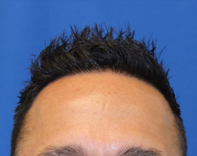 Follicular Unit Extraction Before & After Patient #3791