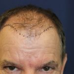 Follicular Unit Extraction Before & After Patient #3680