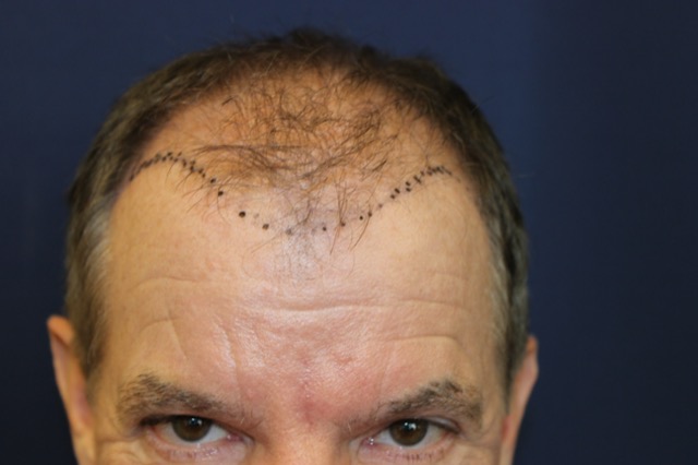 Follicular Unit Extraction Before & After Patient #3680
