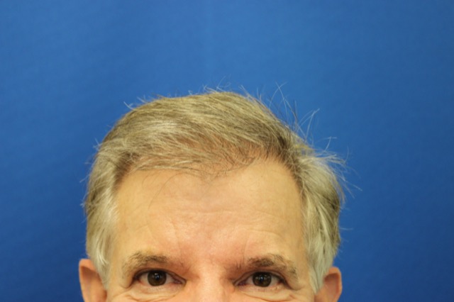 Follicular Unit Extraction Before & After Patient #3680