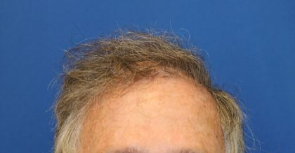 Patient #3505 Follicular Unit Extraction Before and After Photos La Jolla -  Plastic Surgery Gallery San Diego - Dr Richard Chaffoo