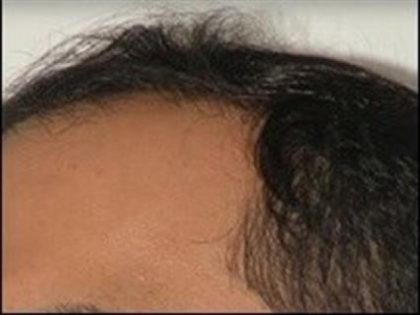 Follicular Unit Extraction Before & After Patient #3568