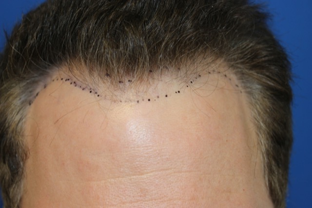 Follicular Unit Extraction Before & After Patient #3747