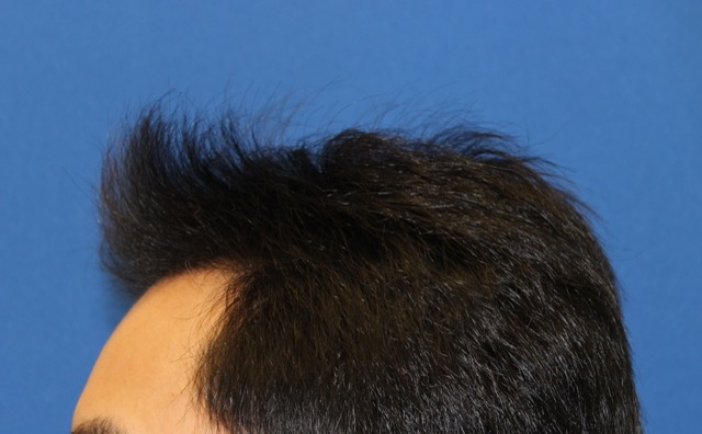 Follicular Unit Extraction Before & After Patient #3711