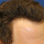 Follicular Unit Extraction Before & After Patient #3747