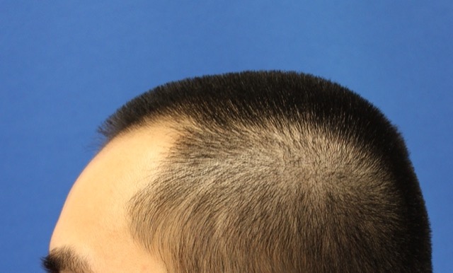 Follicular Unit Extraction Before & After Patient #3711