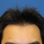 Follicular Unit Extraction Before & After Patient #3711