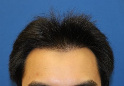 Follicular Unit Extraction Before & After Patient #3711