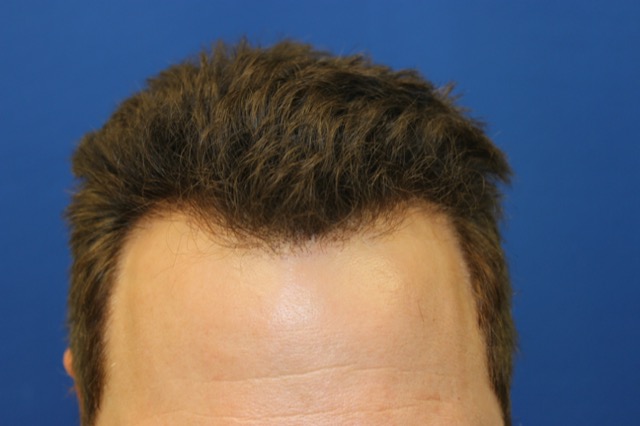 Follicular Unit Extraction Before & After Patient #3747