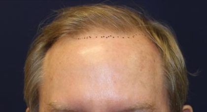 Follicular Unit Extraction Before & After Patient #3668