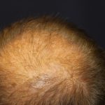 Follicular Unit Extraction Before & After Patient #3680