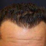 Follicular Unit Extraction Before & After Patient #3617