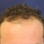 Follicular Unit Extraction Before & After Patient #3617