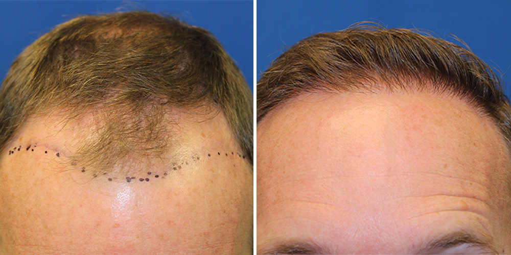 Advances in Hair Restoration | San Diego, Newport Beach, La Jolla & Beverly  Hills, CA