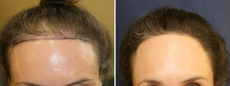 hair Patient