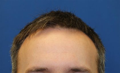 Follicular Unit Extraction Before & After Patient #4396