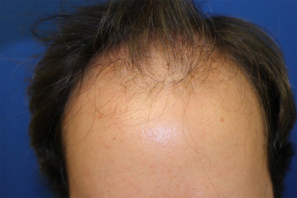 Follicular Unit Extraction Before & After Patient #4378