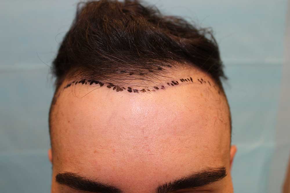 Follicular Unit Extraction Before & After Patient #4438