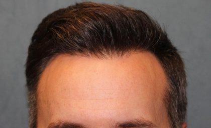 Follicular Unit Extraction Before & After Patient #4396