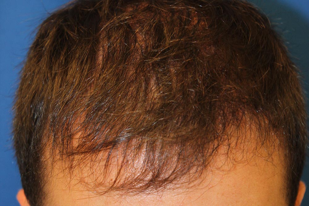 Follicular Unit Extraction Before & After Patient #4378
